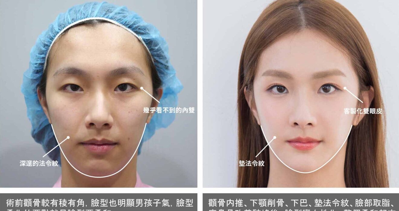 削骨權威-柔化臉部線條讓五官更精緻