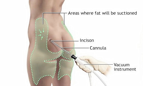 抽脂手術-台北、台中、高雄