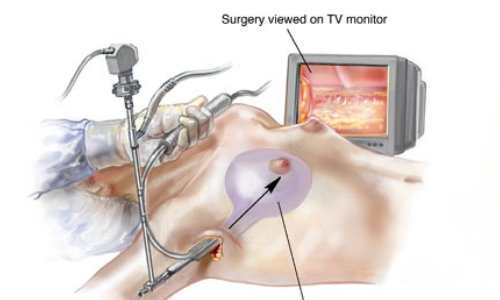 隆乳手術-台北、台中、高雄