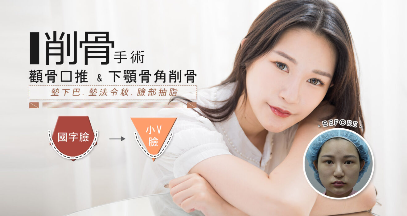 削骨權威郭菁松醫師幫ketty與國字臉做了完整的切割