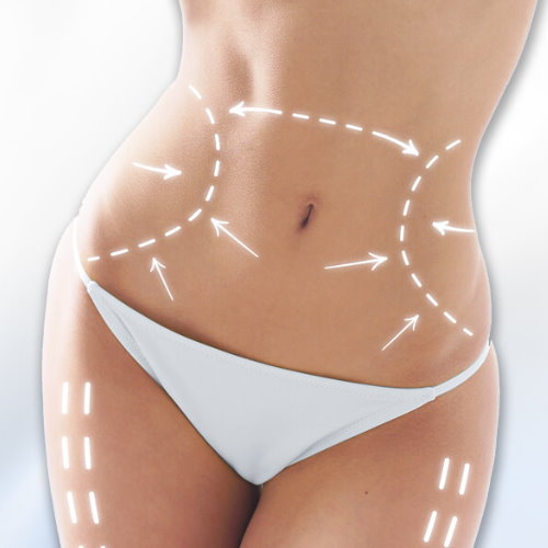 抽脂手術QA懶人包