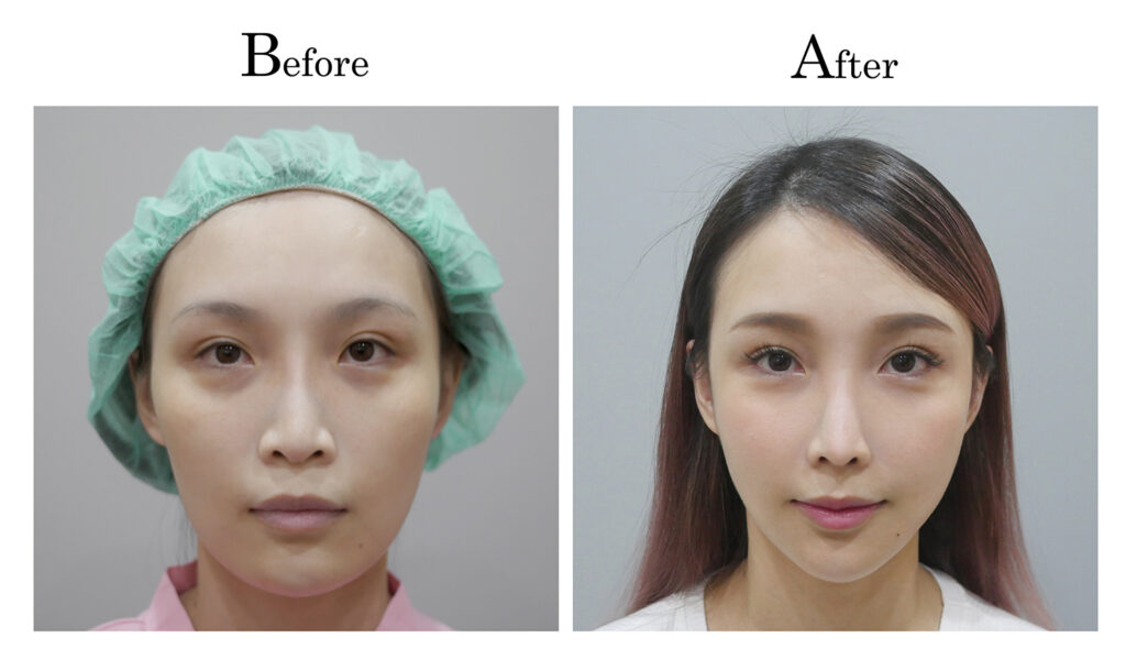 削骨手術前後臉部線條比較。