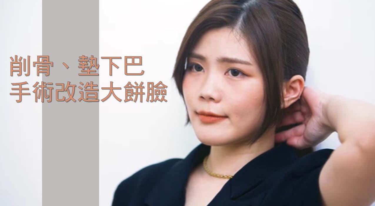 削骨與墊下巴複合式手術成果展示