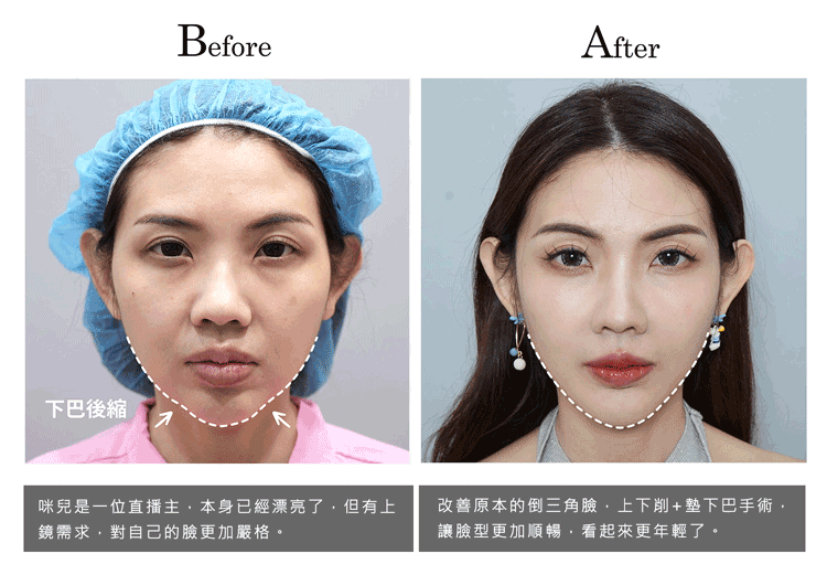 削骨案例成功實錄之直播主咪兒改善倒三角臉,削骨術前術後比較