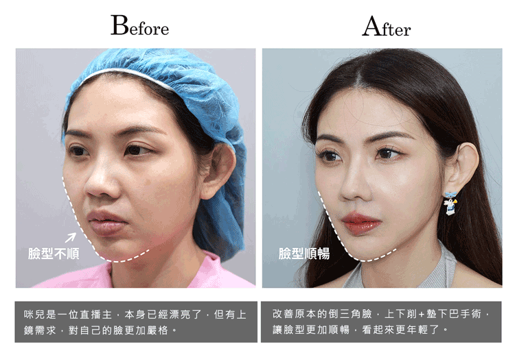削骨案例成功實錄之直播主咪兒改善倒三角臉,進行削骨手術的前後比較