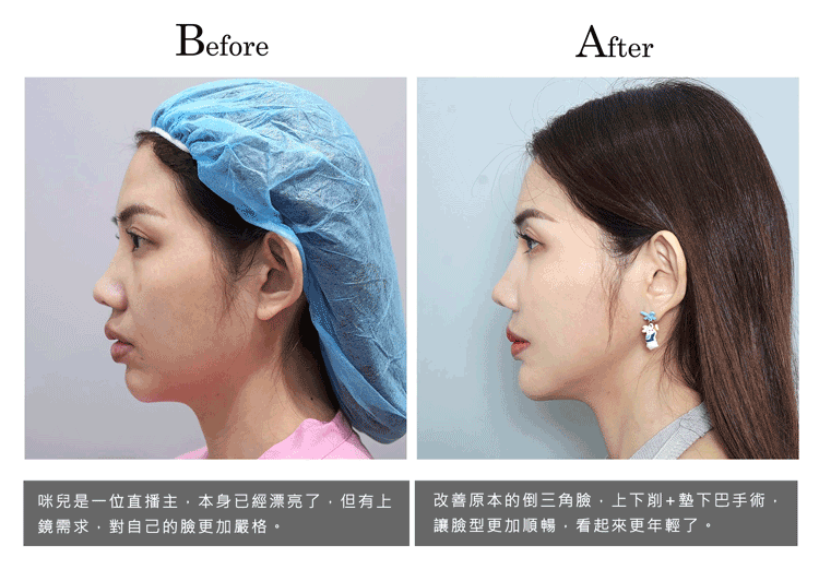 削骨案例成功實錄之直播主咪兒改善倒三角臉,進行削骨與墊下巴手術的前後照片