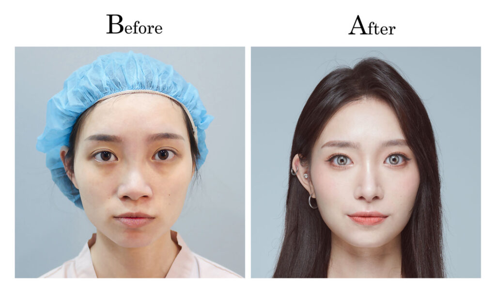 削骨可施作部位:額骨、眉骨、顴骨、下顎骨和下巴